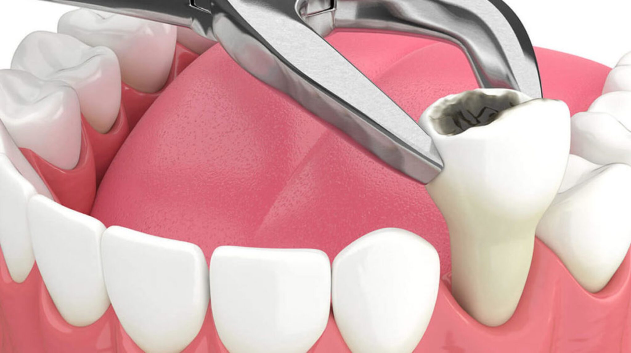 Can you vape after tooth extraction A Comprehensive Analysis Vape